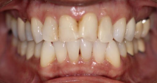 patient teeth 1 before
